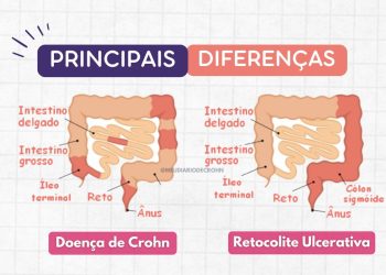 Doença de Crohn x Retocolite Ulcerativa: entenda as principais diferenças entre as DIIs
