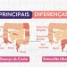 Doença de Crohn x Retocolite Ulcerativa: entenda as principais diferenças entre as DIIs