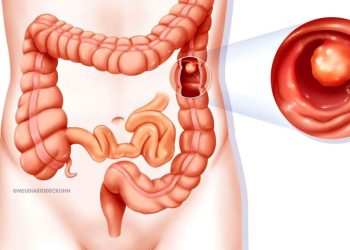 Pólipos no intestino: o que são, quais os riscos e quando se preocupar