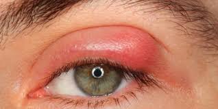 Prevenção do terçol deve ser reforçada no verão